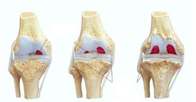 घुटने के जोड़ के आर्थ्रोसिस के चरण