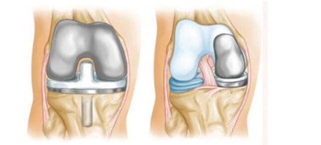 घुटने के जोड़ के आर्थ्रोसिस के लिए आर्थ्रोप्लास्टी