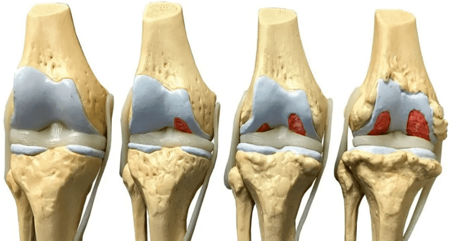 आर्थ्रोसिस विकास के विभिन्न चरणों में घुटने के जोड़ को नुकसान