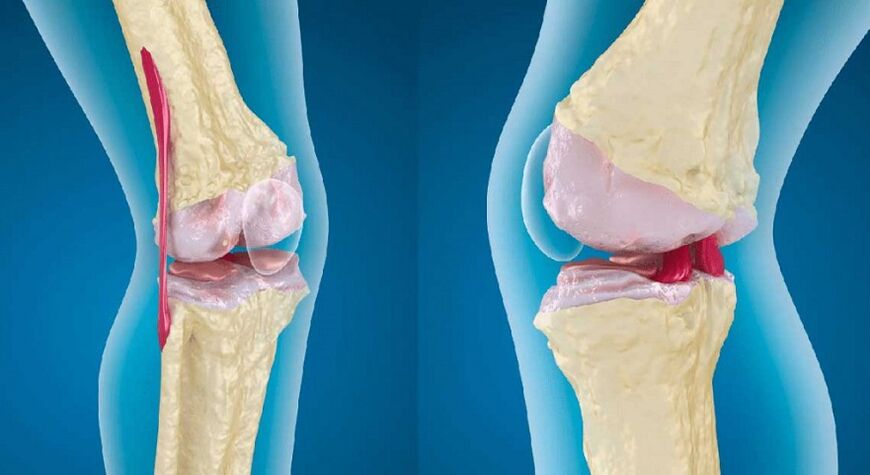 घुटने के जोड़ के स्वस्थ जोड़ और आर्थ्रोसिस