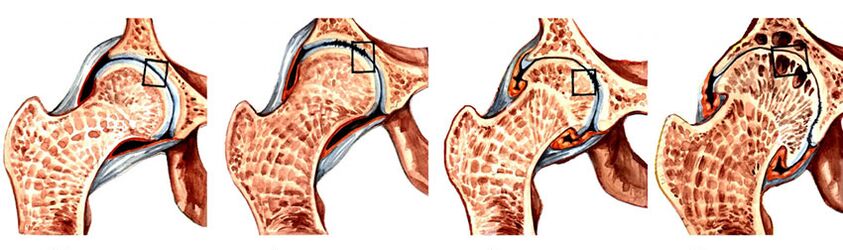 कूल्हे के जोड़ के आर्थ्रोसिस के विकास की डिग्री