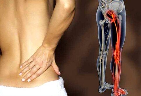 कटिस्नायुशूल तंत्रिका की सूजन के कारण पीठ के निचले हिस्से में दर्द