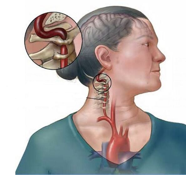 ग्रीवा ओस्टियोचोन्ड्रोसिस के साथ कशेरुका धमनी सिंड्रोम