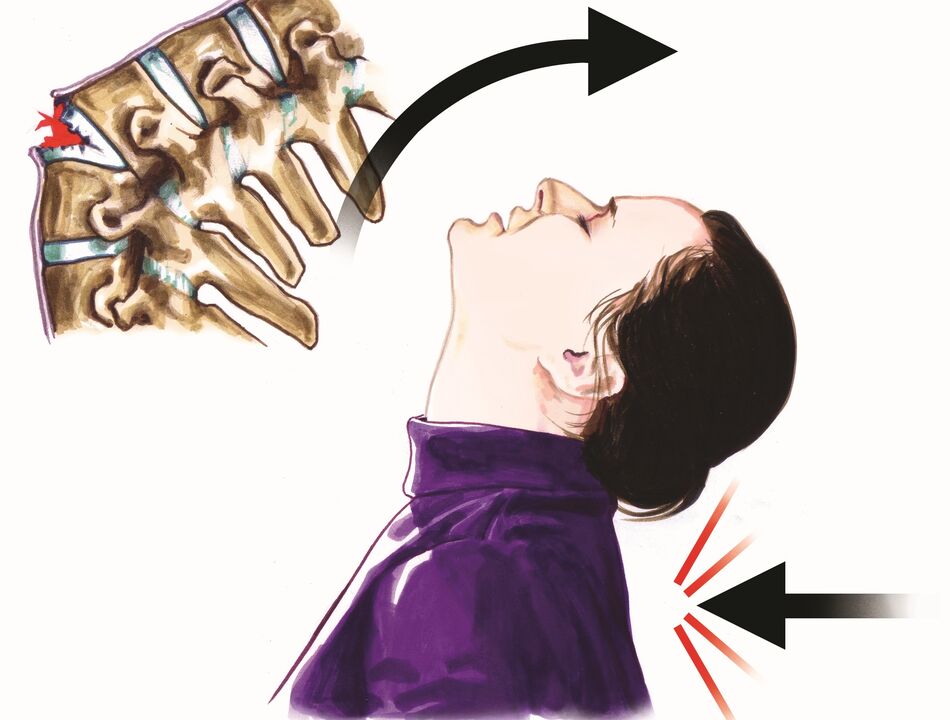 गर्दन के दर्द का कारण रीढ़ की हड्डी की क्षति